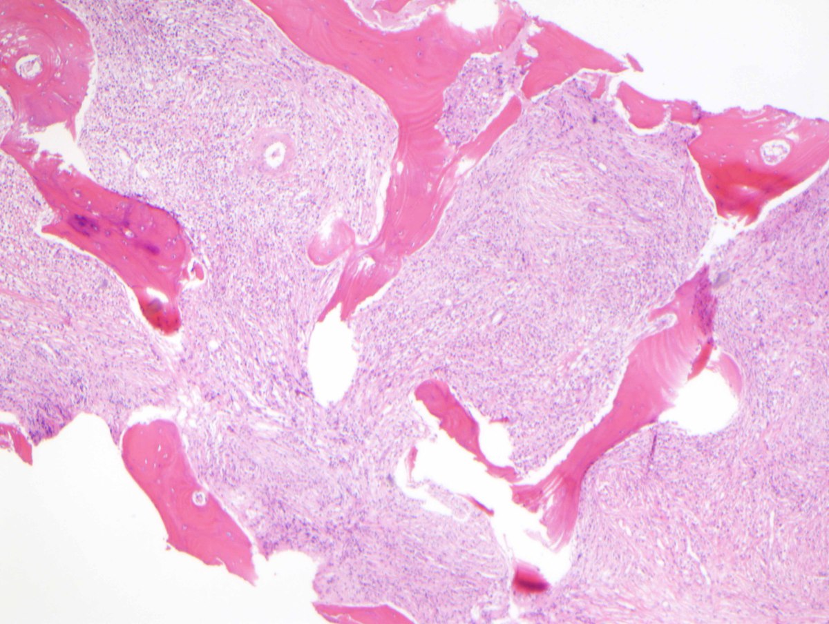 D) Bone marrow trephine biopsy with a fibrotic appearance at low power, slight osteosclerosis and decreased overall cellularity (H&E, 100x)